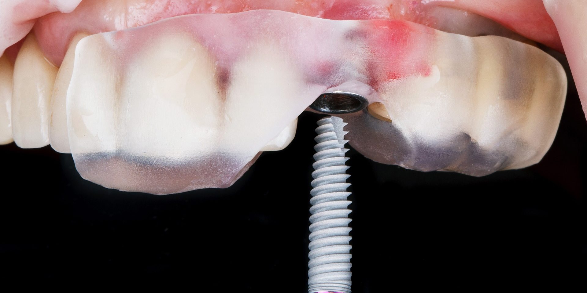 dental implant before insertion through a surgical template for accuracy; Shutterstock ID 1865389156; purchase_order: -; job: -; client: -; other: -