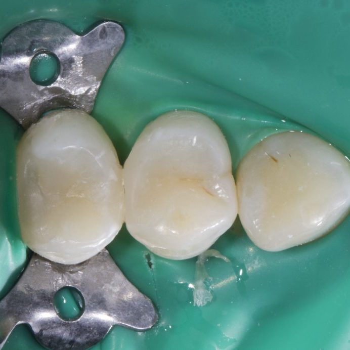 4. Проведено лечение зуба
