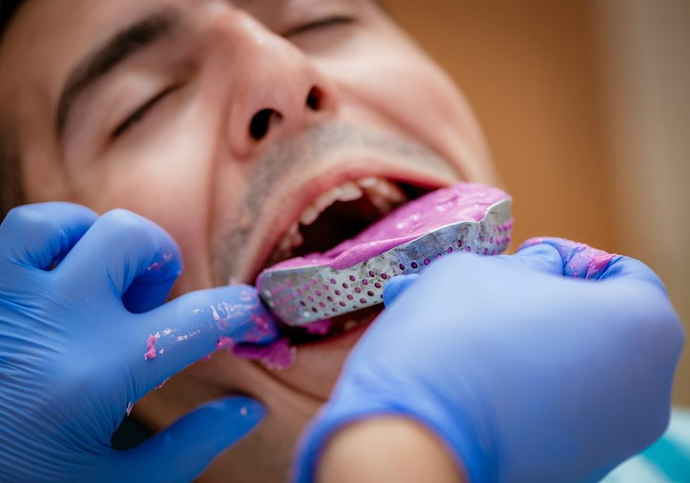 Dentist using dental impression for braces to the male patient. Close-up. Real people.; Shutterstock ID 539379172; purchase_order: -; job: -; client: -; other: -